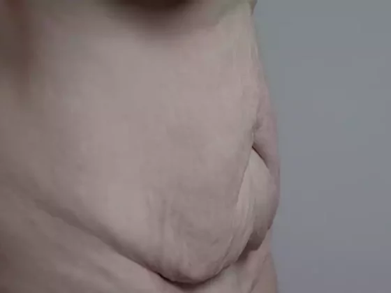 hanging skin after weight loss