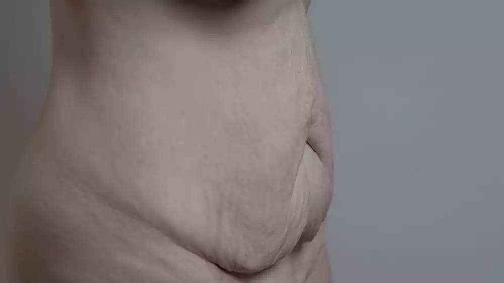 hanging skin after weight loss